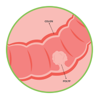 colon inset with colon and polyp anatomy labelled (c) CancerCare Manitoba