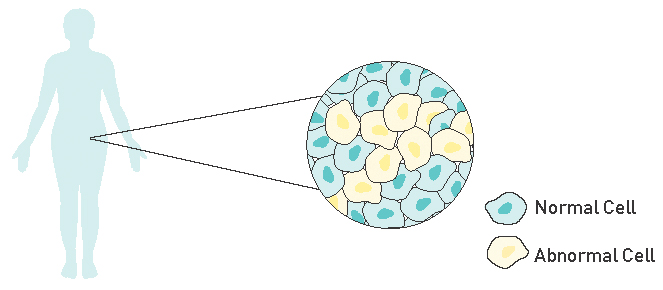 Diagram of how Normal Cells look in the body versus Abnormal Cells (c) CCMB