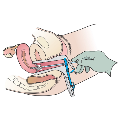 Pap test side view of anatomy complete with broom and speculum (c) CancerCare Manitoba